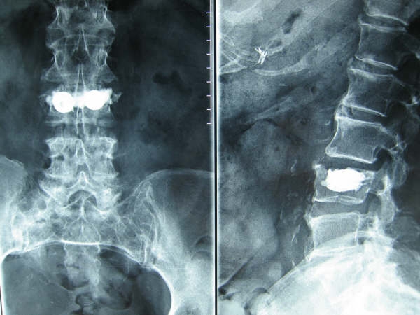 Así luce en radiografía una vértebra fracturada. Imagen de referencia. 