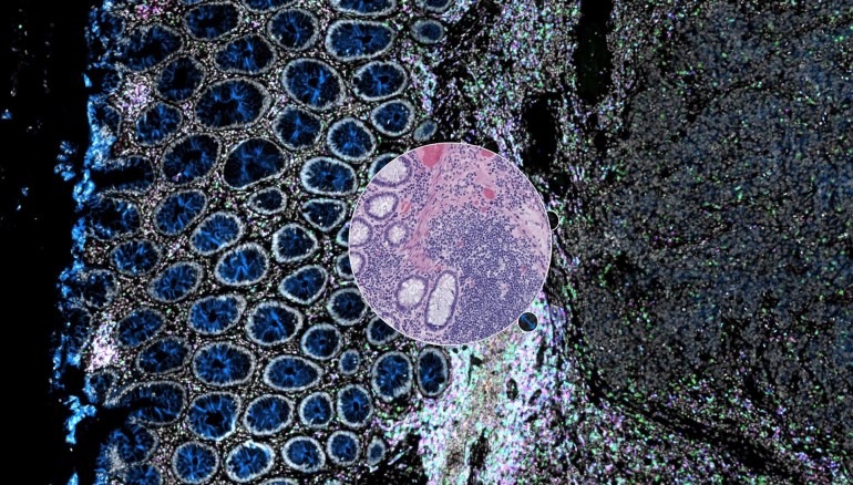 Con Orion, los patólogos pueden identificar un área de interés en una muestra tumoral basándose en los detalles moleculares de las imágenes de inmunofluorescencia, y superponer información estructural utilizando una "lente" de tinción histológica (círculo). Crédito: Laboratorios Santagata y Sorger