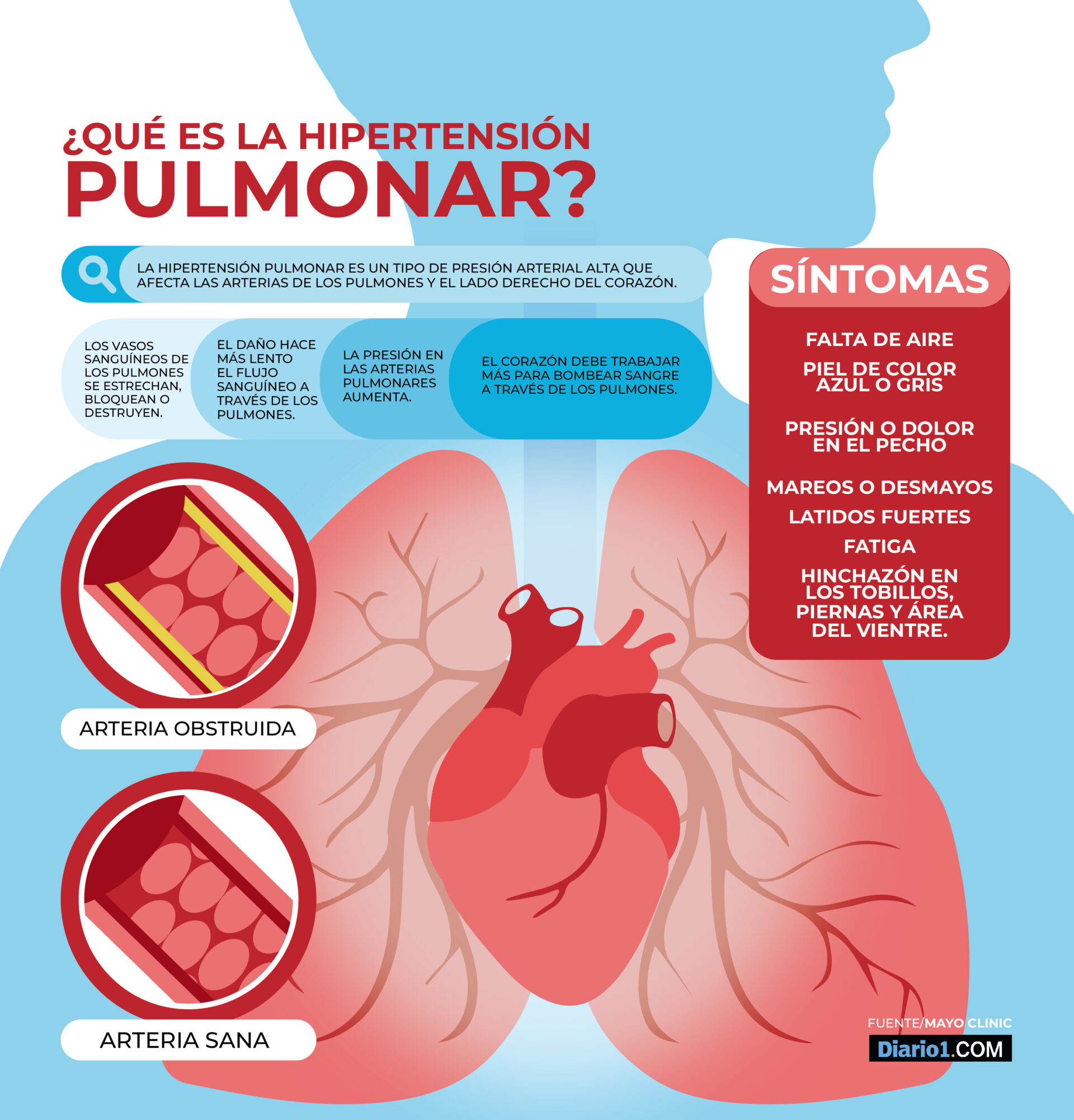 La Hipertensi n Pulmonar El Enemigo Oculto Que Acecha Coraz n Y 
